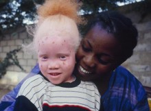 Saviez-Vous que albinos tanzanie fortune