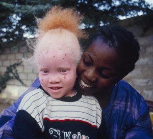 Saviez-Vous que albinos tanzanie fortune